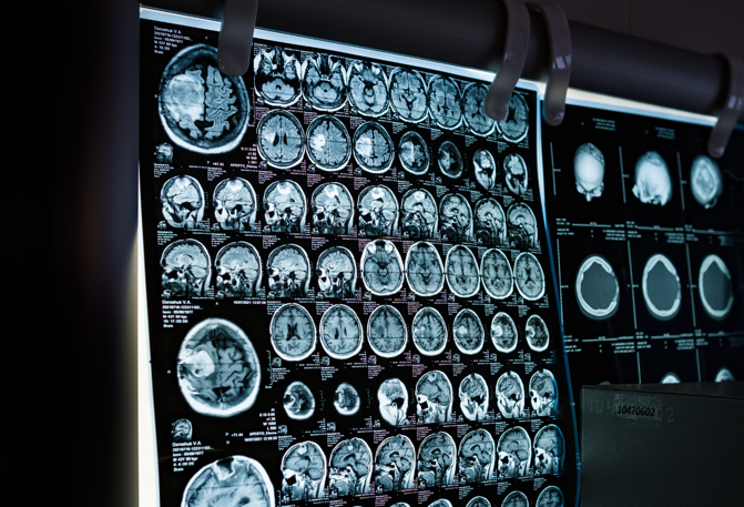 Surviving Four Brain Aneurysms: How OBH Saved Her Life&nbsp;