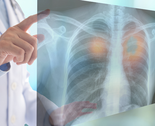 Lung Cancer